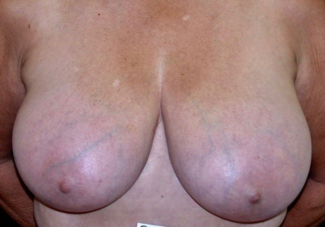 Before-Breast Reduction Lollipop Technique 2