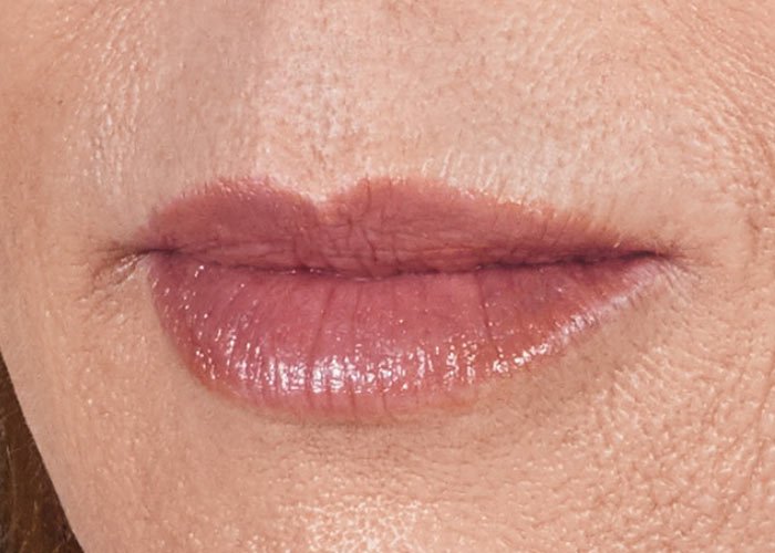 After-Lip Fillers Case 1 Close up