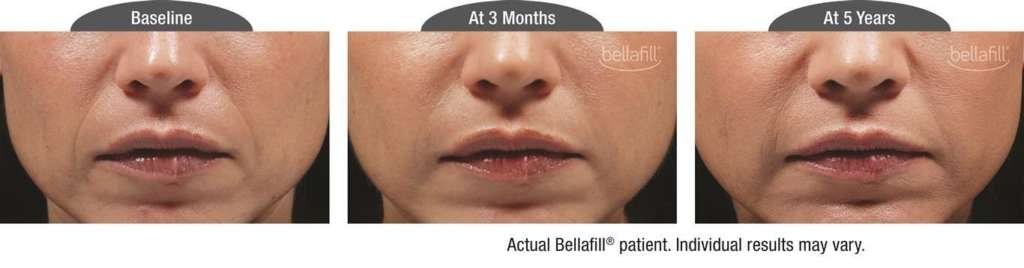 nasolabial b&a_Patient 7