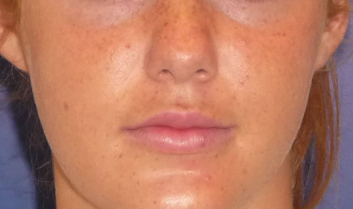 After-Lip Fillers Young Woman