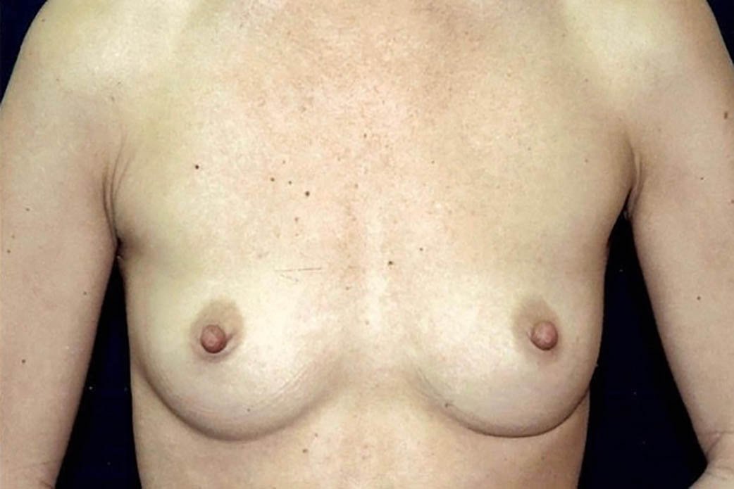 Before-Breast Augmentation 4